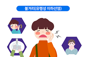 볼거리(유행성 이하선염)